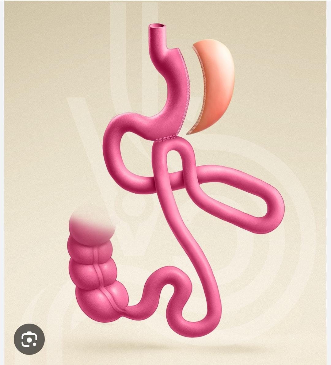 Bipartición Intestinal tipo SASI